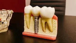 Implant dentar cu anestezie sau sedare? Ce optiuni exista si cand pot fi recomandate