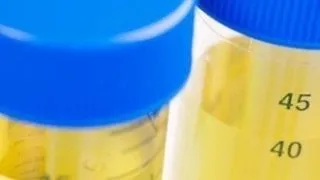 Culoarea urinei indica probleme de sanatate