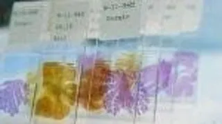 Dieta mai saraca in calorii, pentru prevenirea Alzheimerului